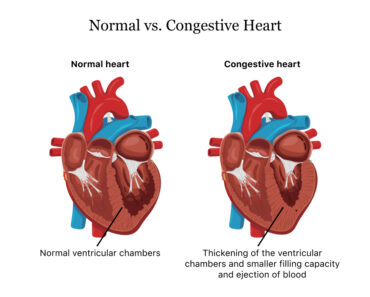 Cardiac Failure Heart Failure | Best Article on Heart in 2022