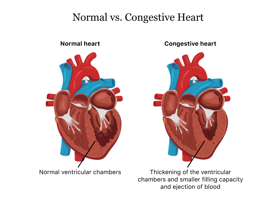 Cardiac Failure Heart Failure