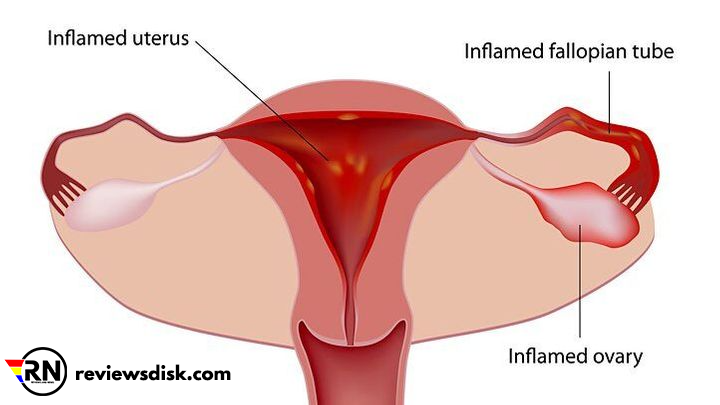 Treatment of Painful Periods